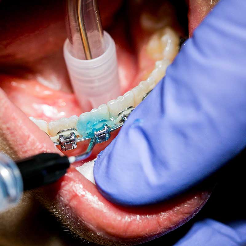 Photo santé Marseille : gros plan de la pose d'un appareil dentaire par un orthodontiste avec des gants bleus de protection.